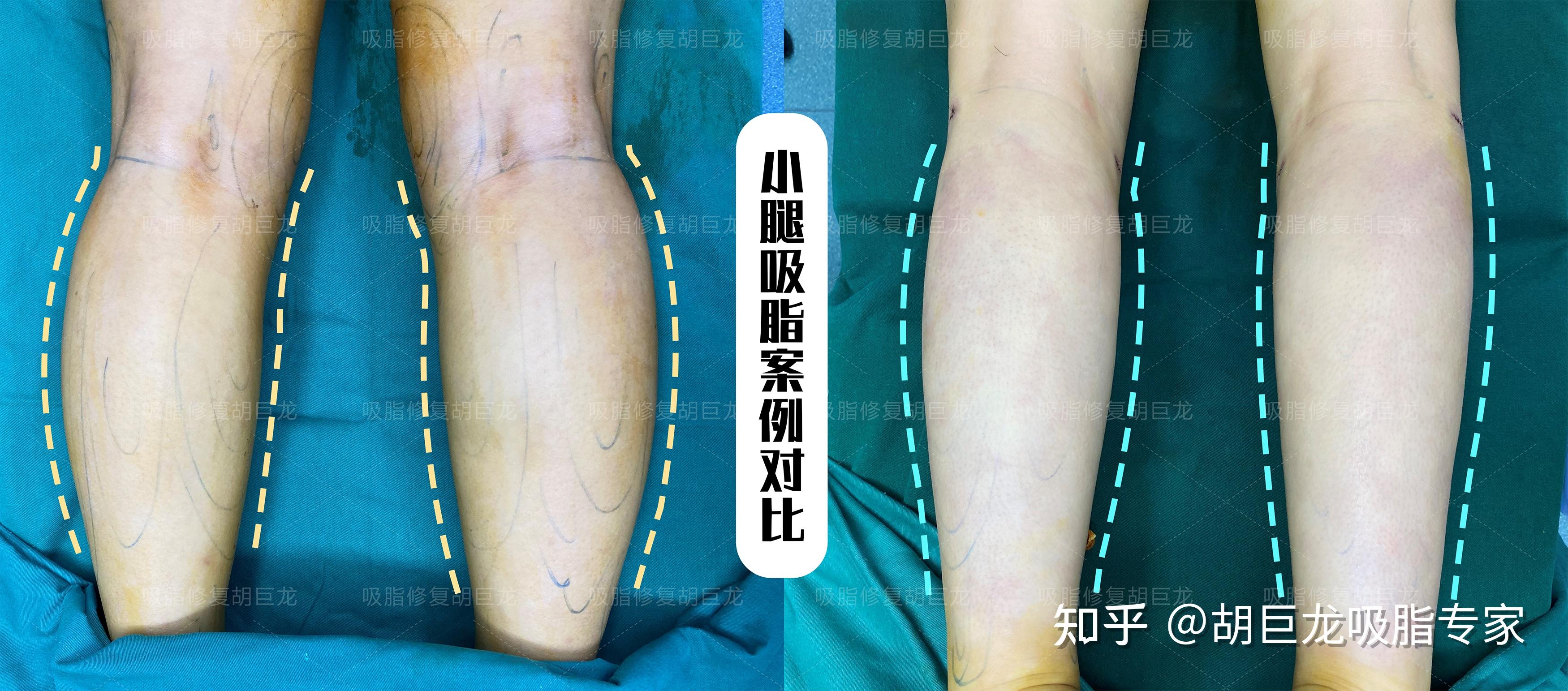 我院普外科成功开展下肢大隐静脉曲张的微创治疗-汉滨区第三人民医院