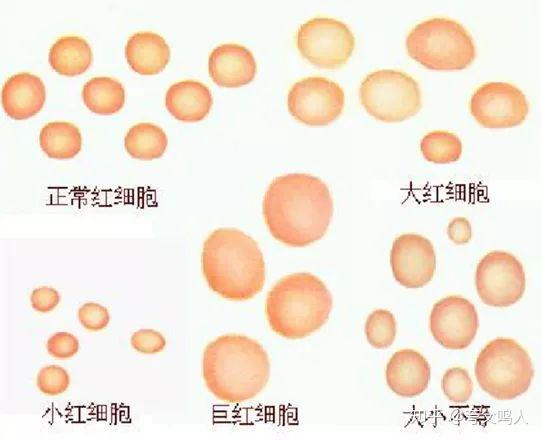 请问为什么巨幼红细胞抗低渗,脆性小?