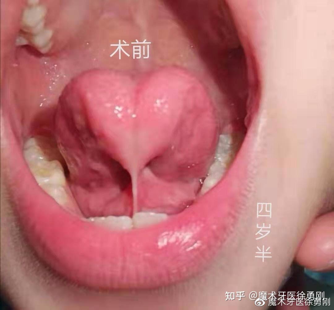 正常人的舌系带图片