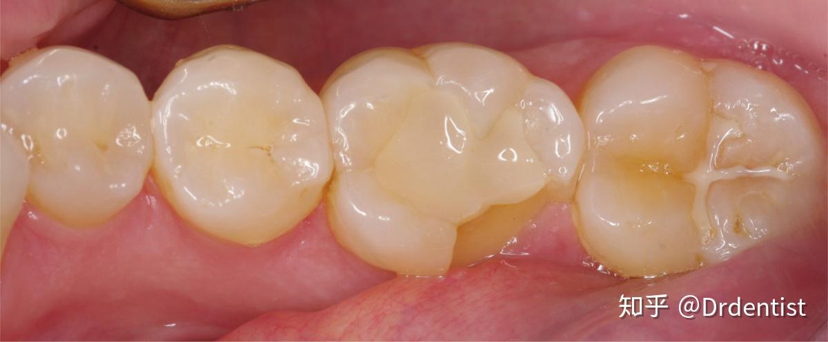 牙医怎么发现患者牙隐裂的