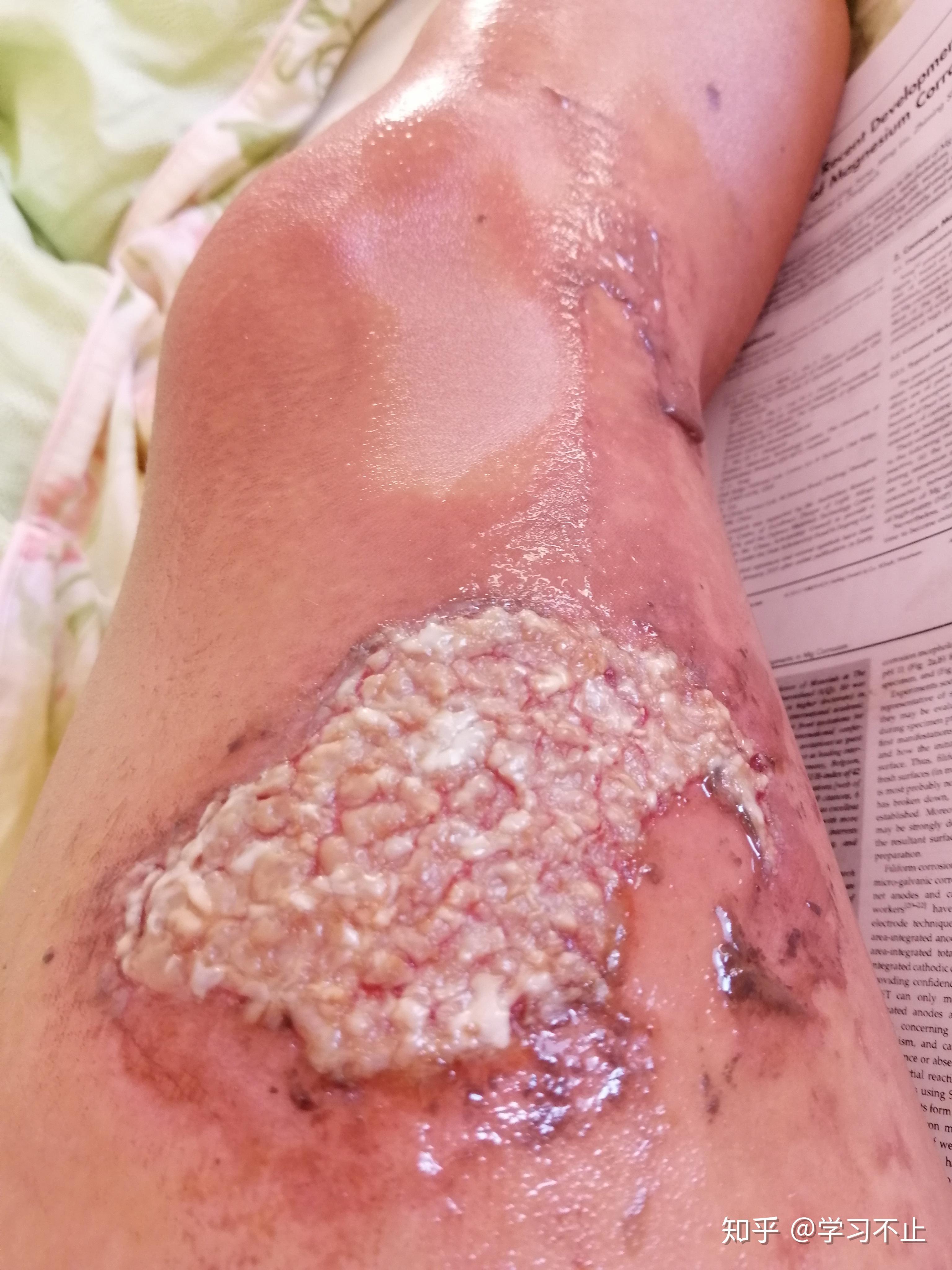 巴黎烫伤脱皮记