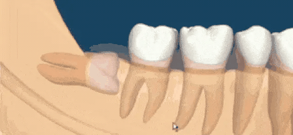 智齿发炎可以直接拔掉吗 知乎