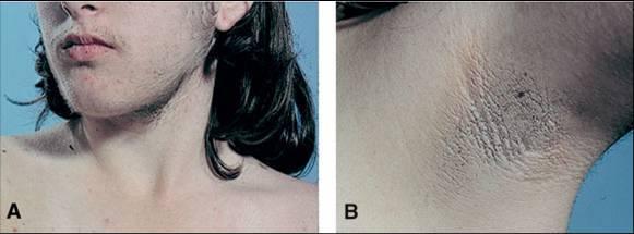 伊美葆讲解多囊卵巢综合征症状黑棘皮症