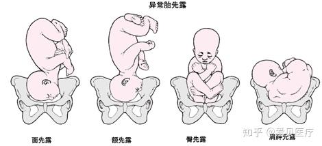 哪些胎位属于胎位不正