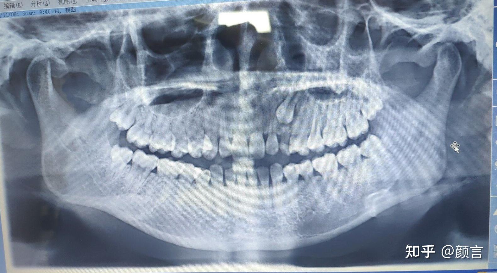 案例：正畸牵引水平阻生智齿代替缺失磨牙 - 哔哩哔哩