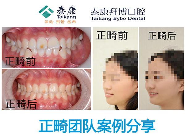 重庆牙齿矫正:凸面型,牙齿外突+金属托槽正畸案例 - 知乎