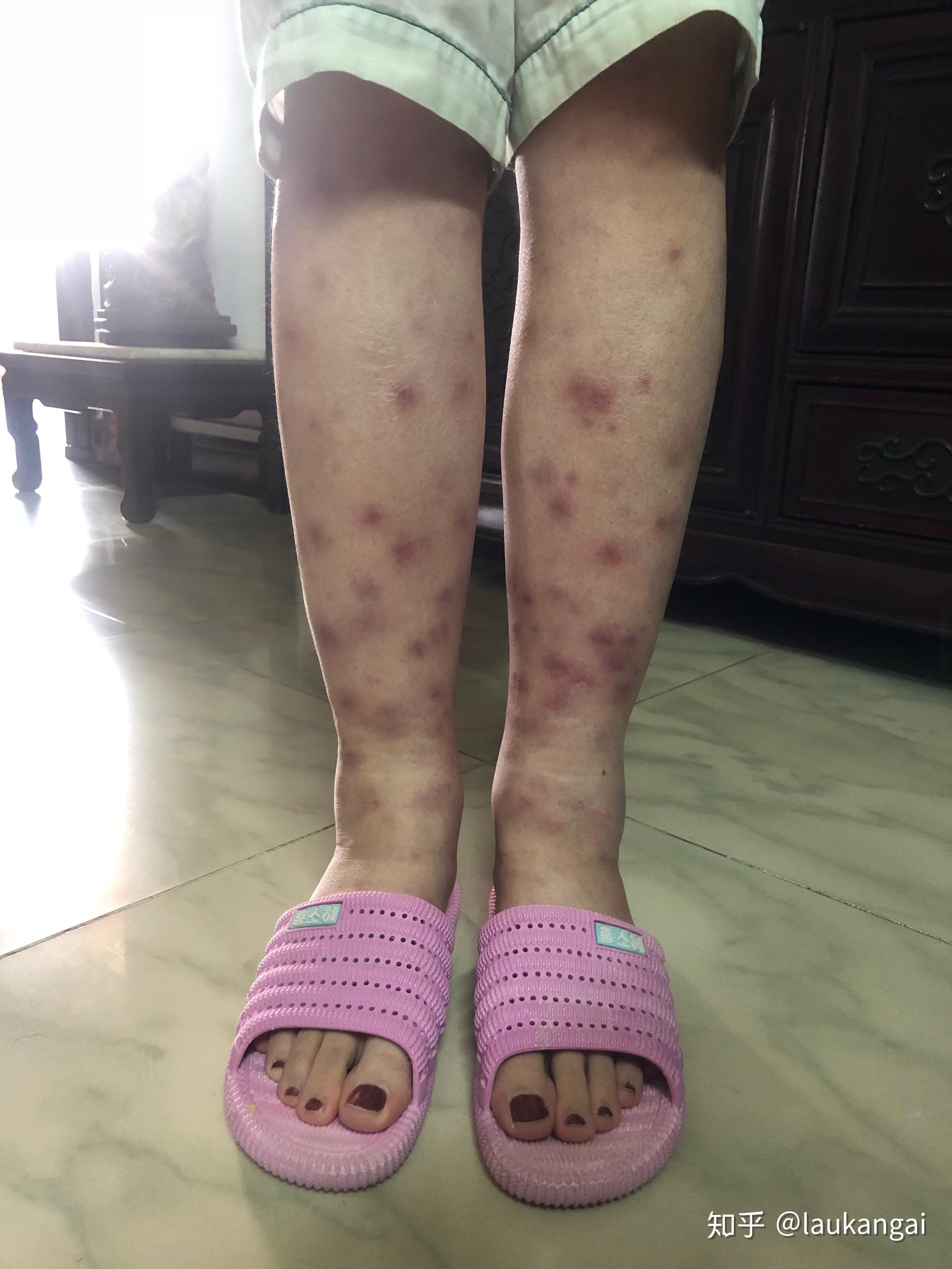 得过结节性红斑的人过来交流下? - 知乎