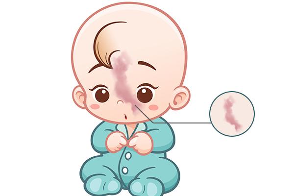 还把鲜红斑痣当做普通胎记吗治疗一定要趁早