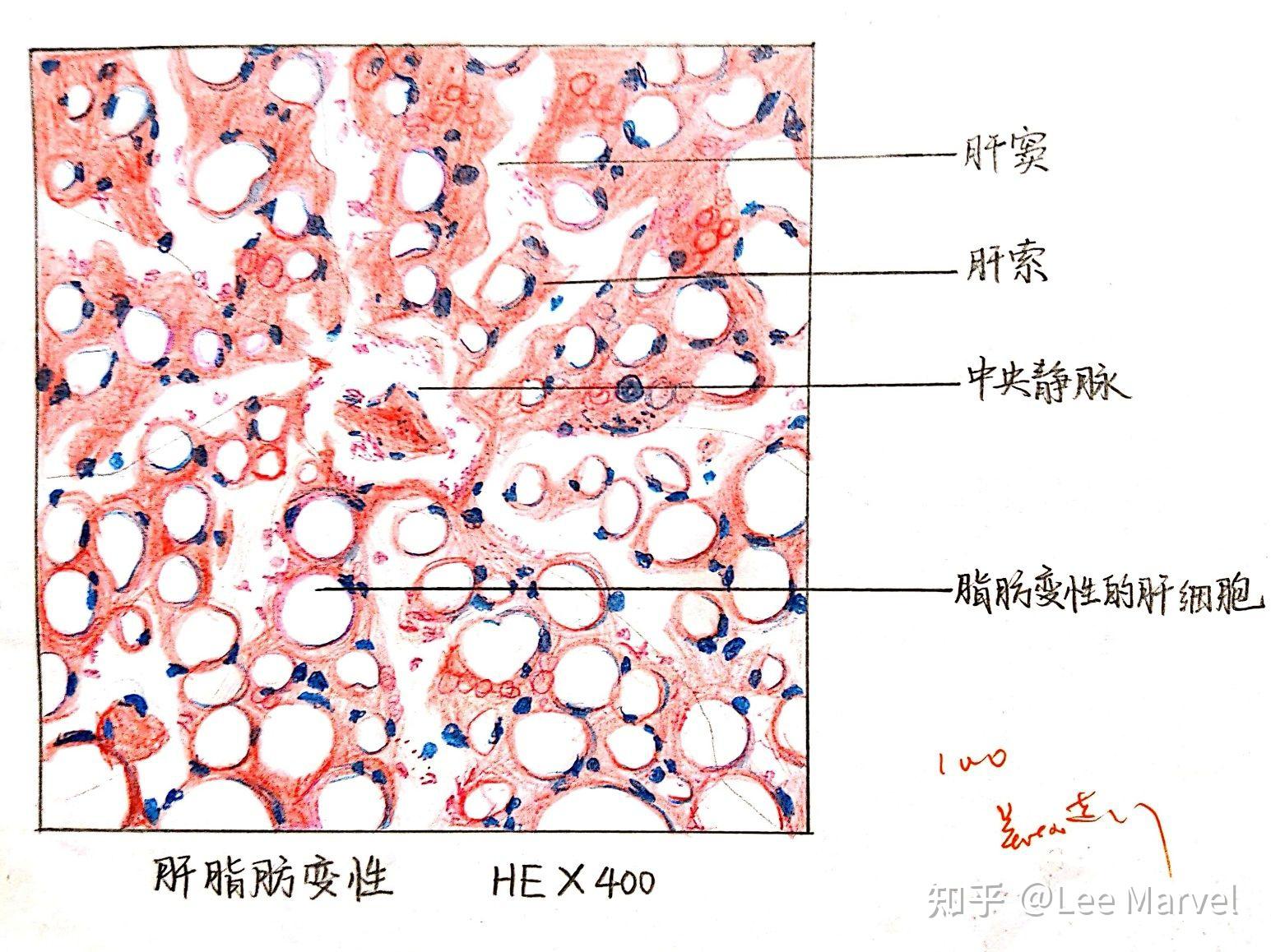 肝细胞脂肪变手绘图图片