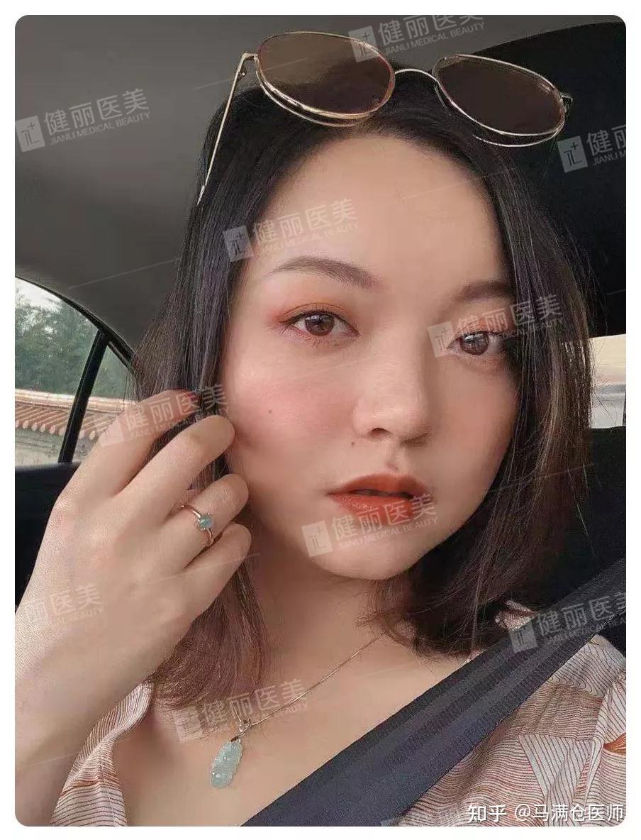 去掉4年的眼袋+泪沟后，她晒出多角度高清照，效果好赞！ - 知乎