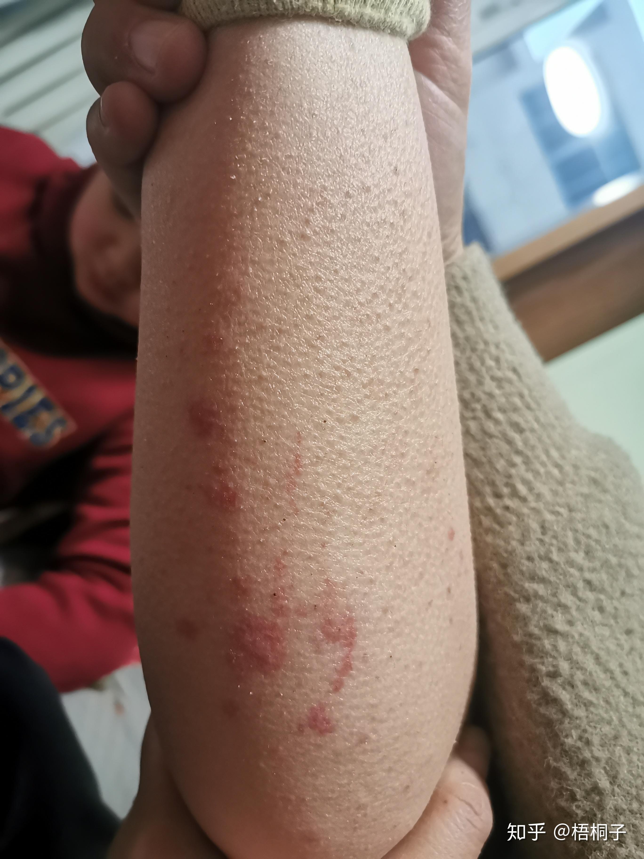 小朋友腿上起红斑是啥情况