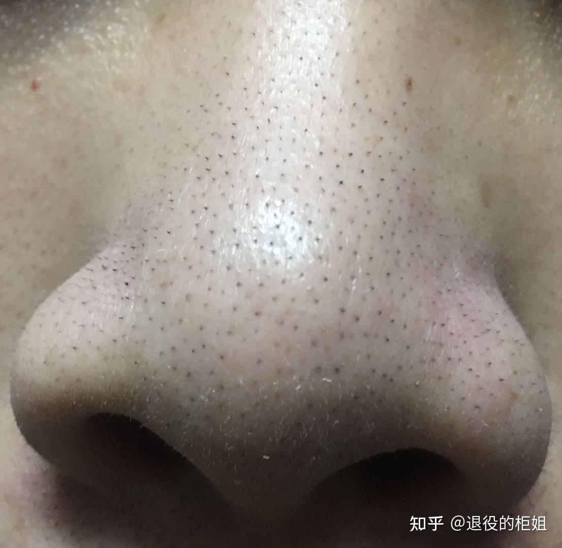 黑头的本质是什么?如何区别黑头? - 知乎