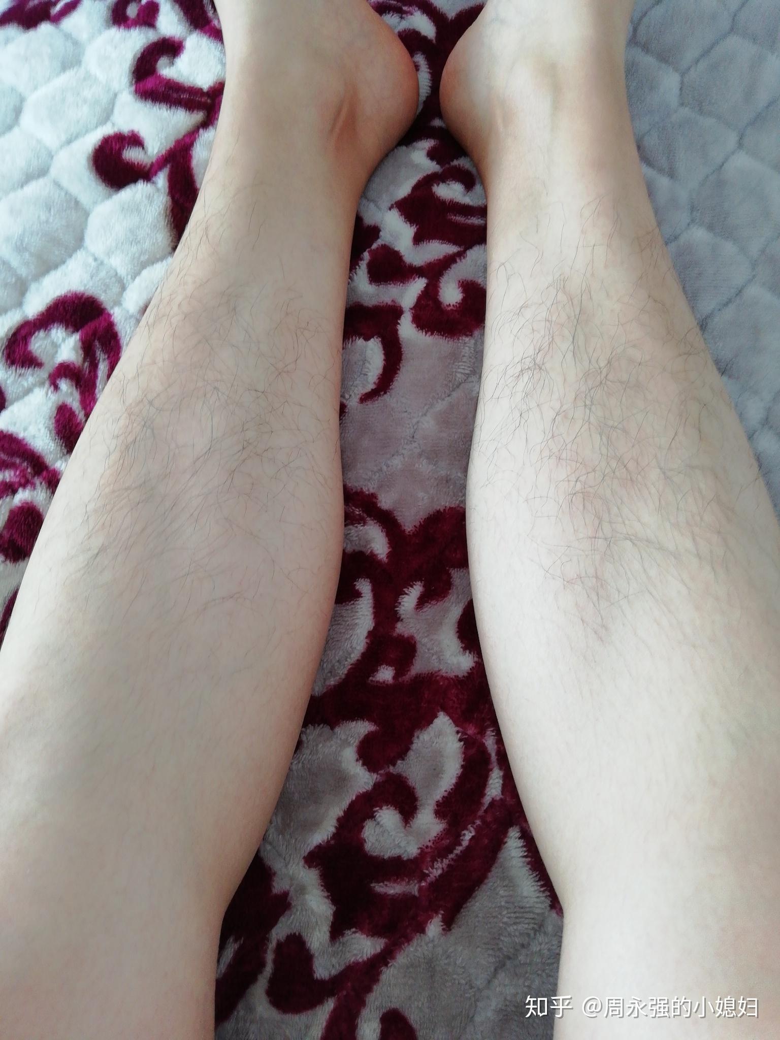 女生有腿毛怎么办