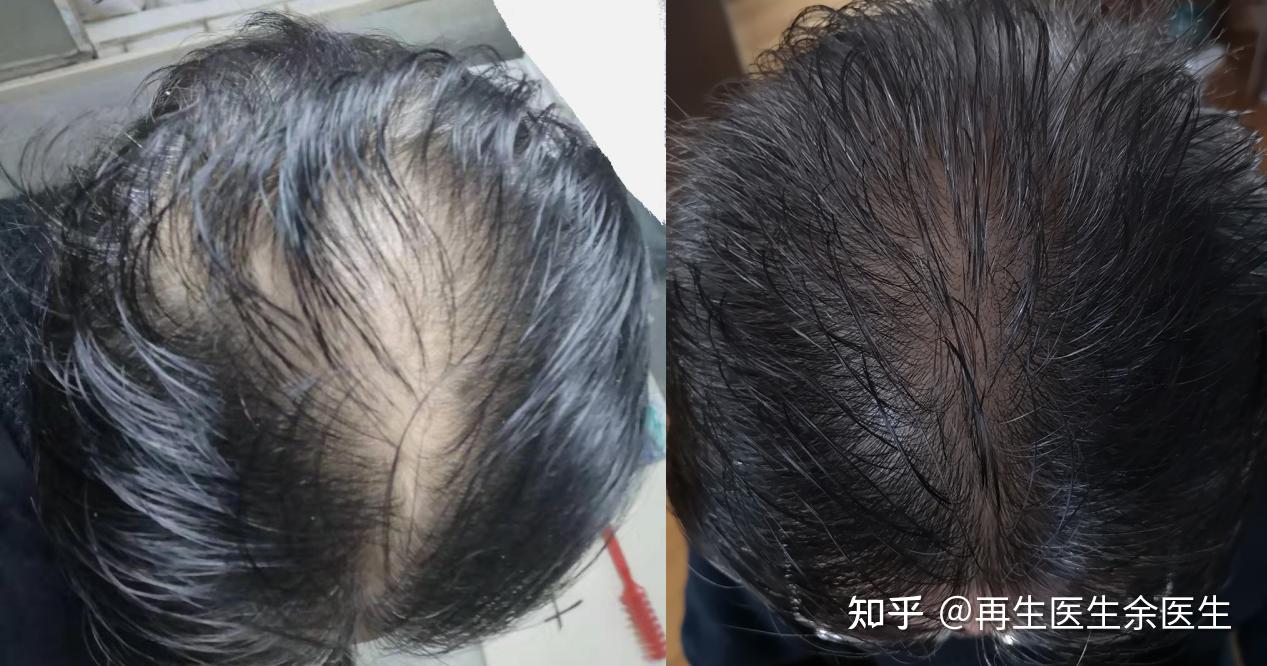 脱发有救了?外泌体让毛囊重新激活修复 - 知乎