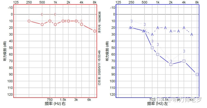 【案例分享】牙骨传导技术干预单侧听力损失（突发性聋） - 知乎