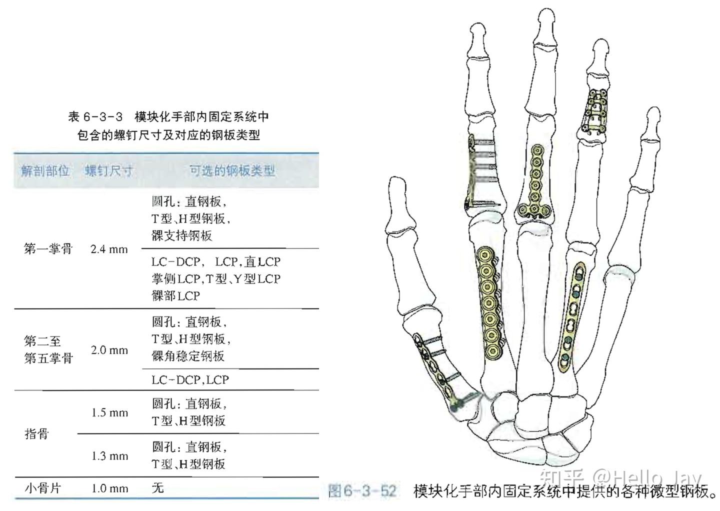 手部骨折的治疗原则 - 知乎