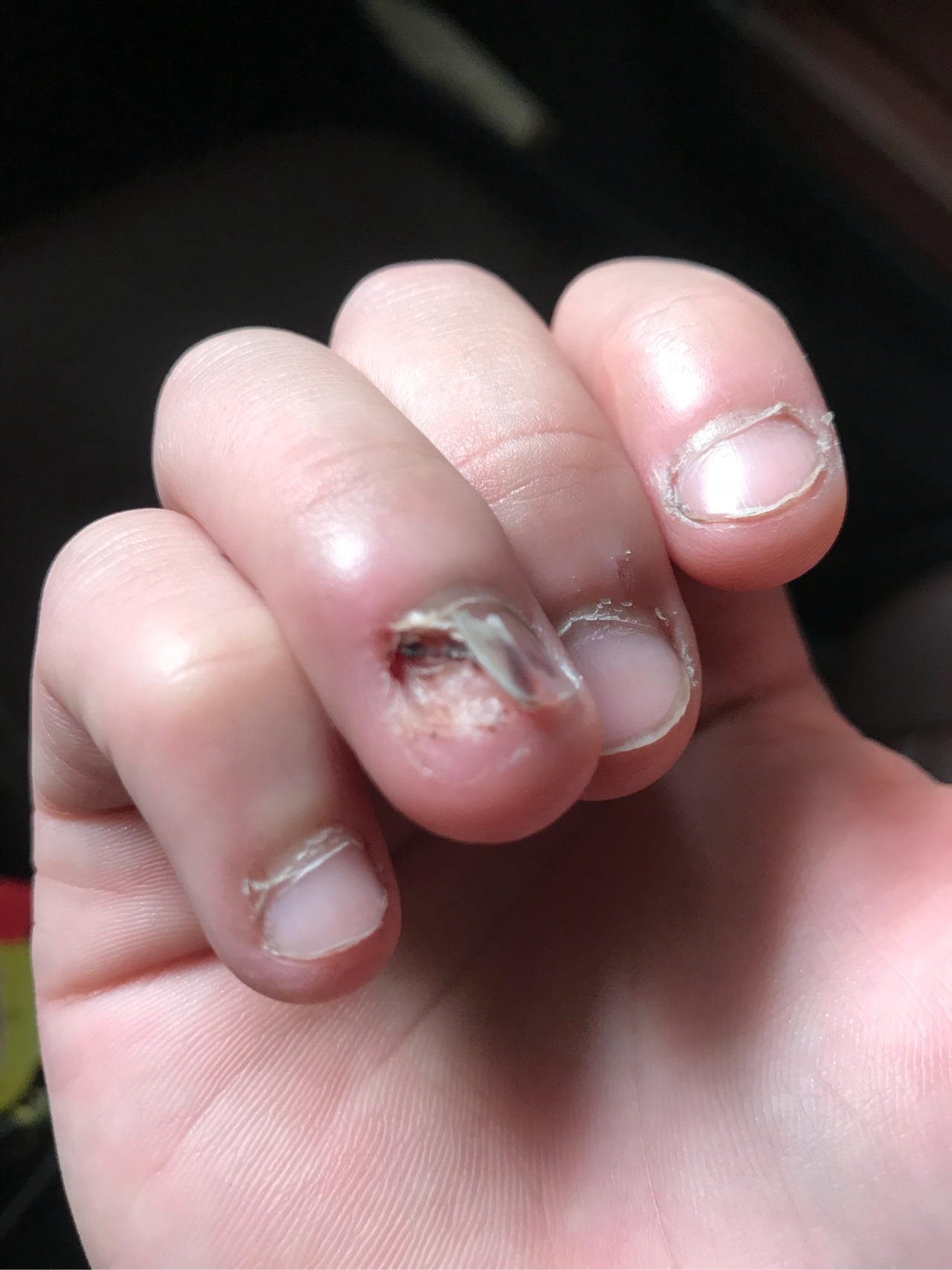 手指甲被玻璃门甲这样长出来会和原来一样吗有图