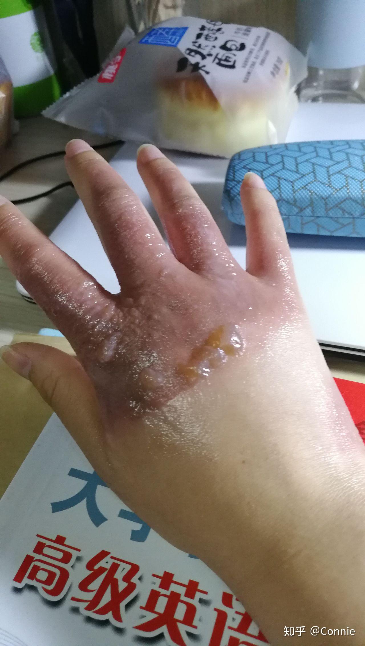 手被开水烫伤了怎么办