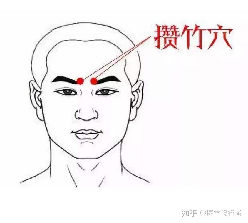 攒竹穴治呃逆意想不到的效果