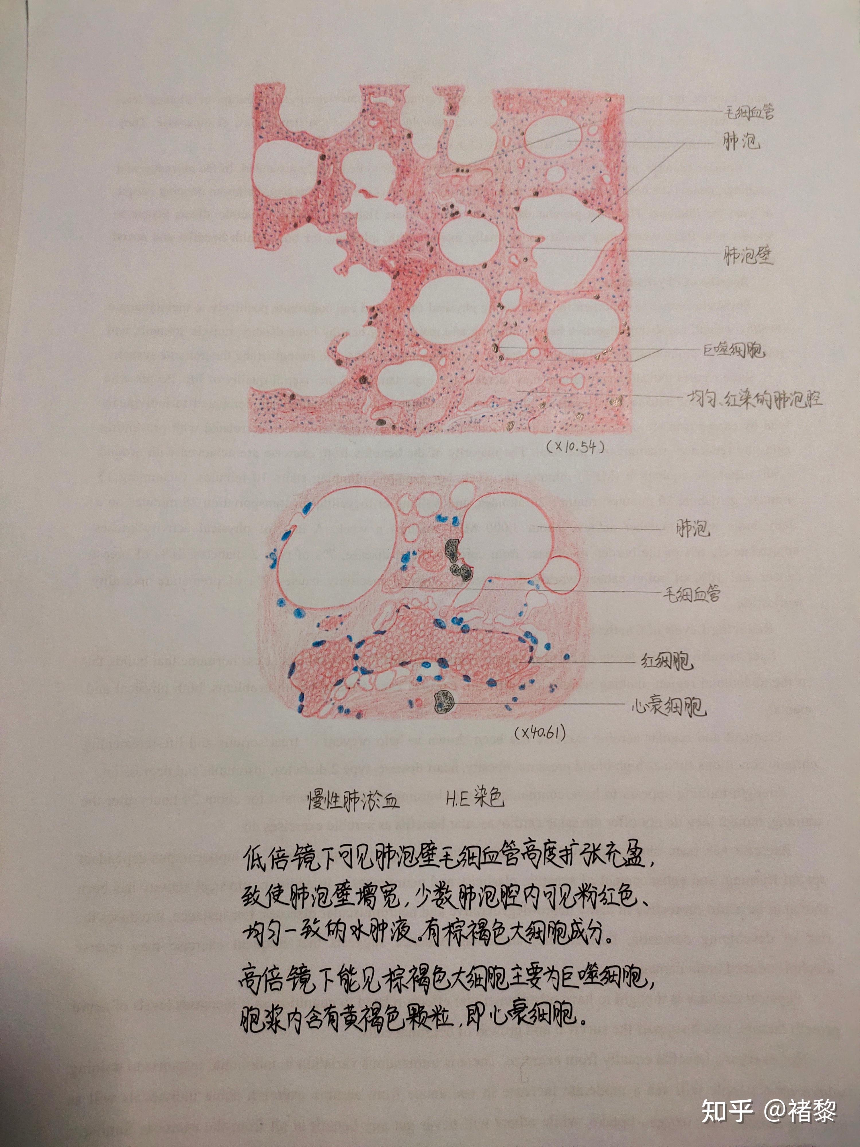 有没有人有病理的结肠腺癌红蓝铅笔手绘图啊? - 知乎