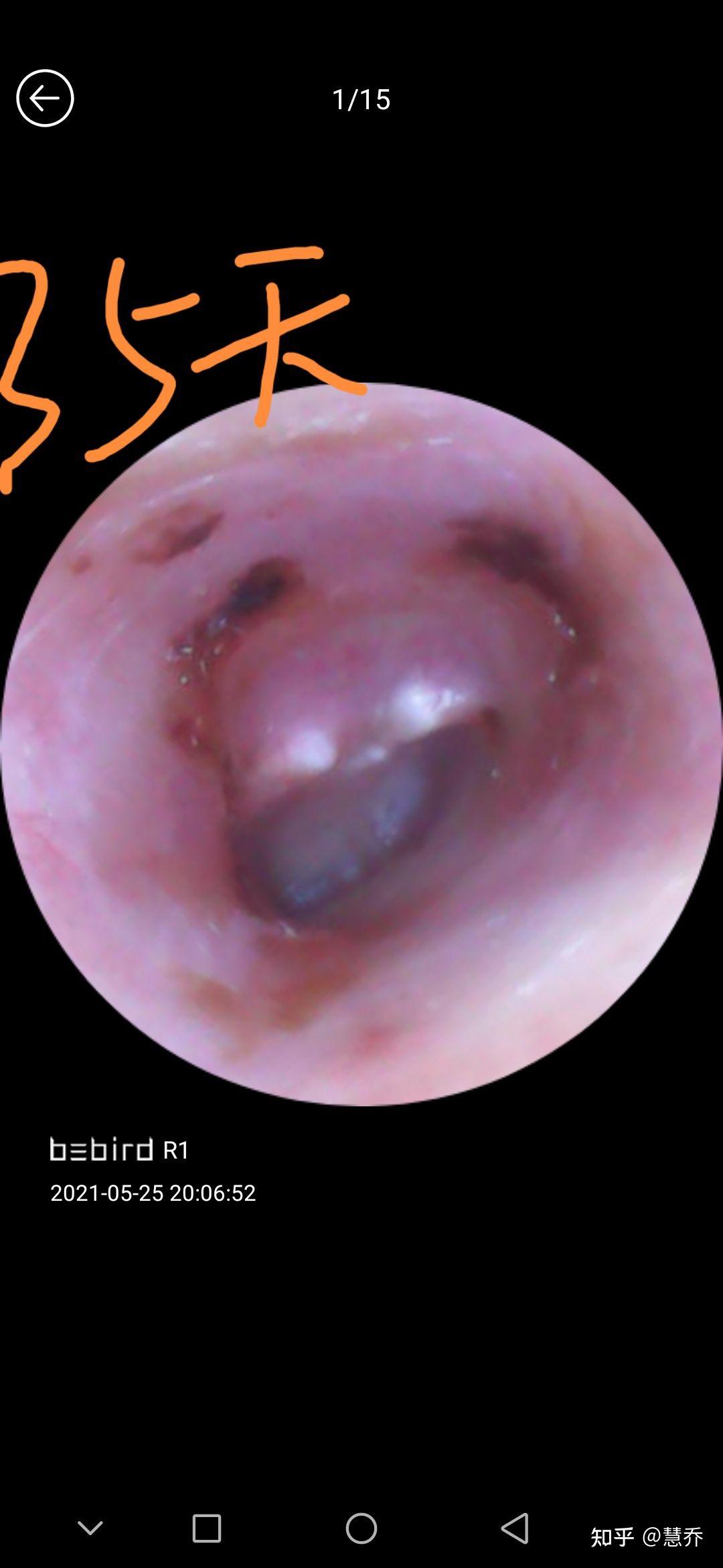 回馈病友双耳鼓膜修复手术