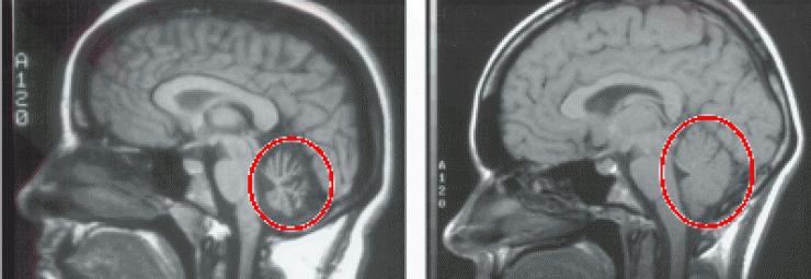 小脑萎缩早期症状病人,家人如何帮助治疗? - 知乎