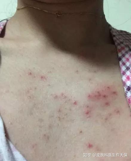 痤疮和毛囊炎如何区分掌握这6招