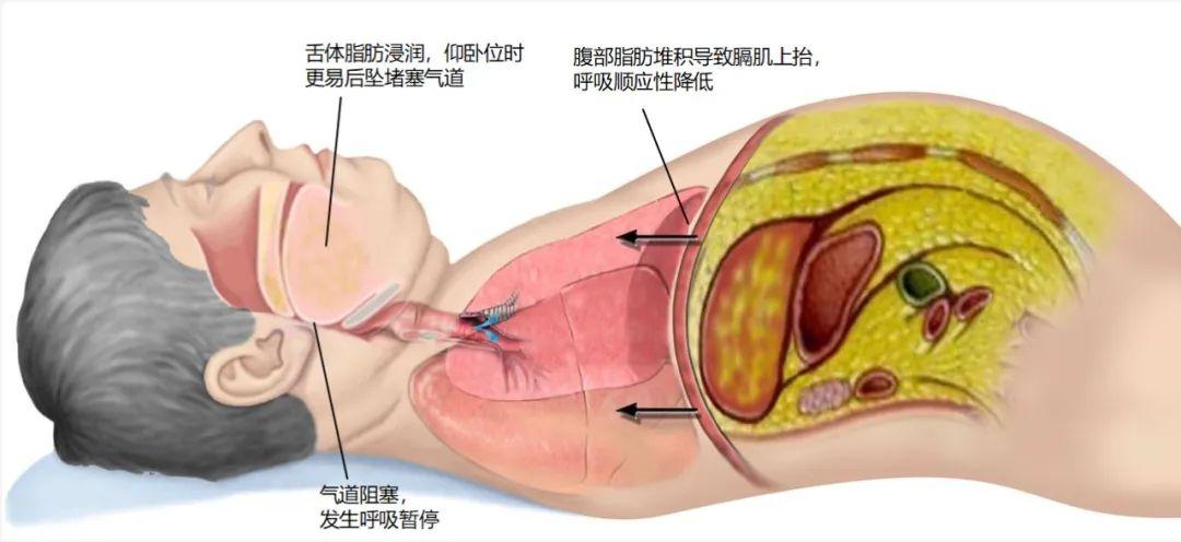 肥胖患者为什么打鼾严重?