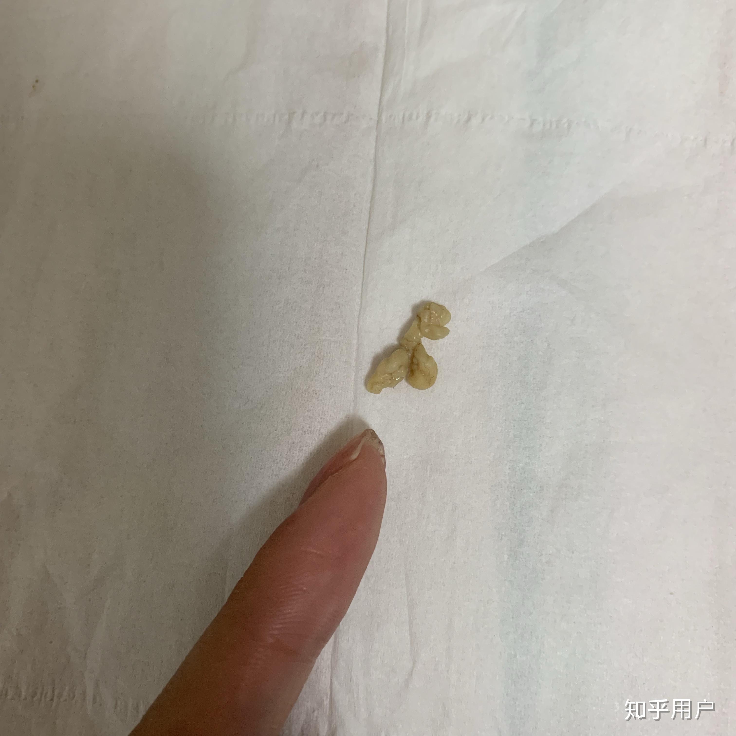 你见过最大的扁桃体结石有多大? - 知乎