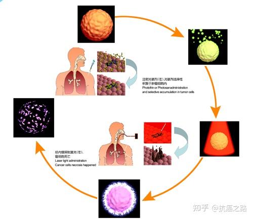光动力疗法有哪些优缺点? - 知乎