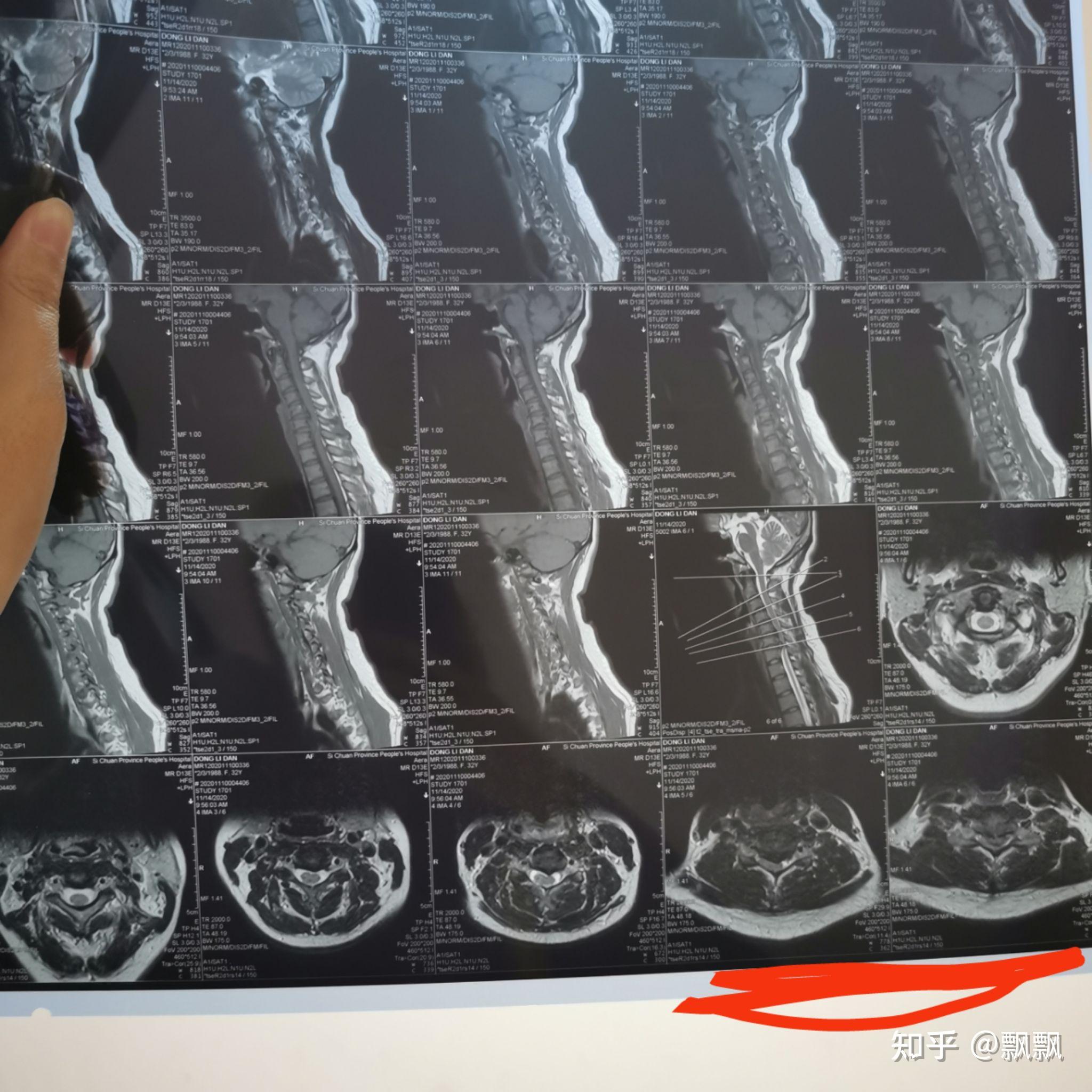 脊髓型頸椎病從確診到治療