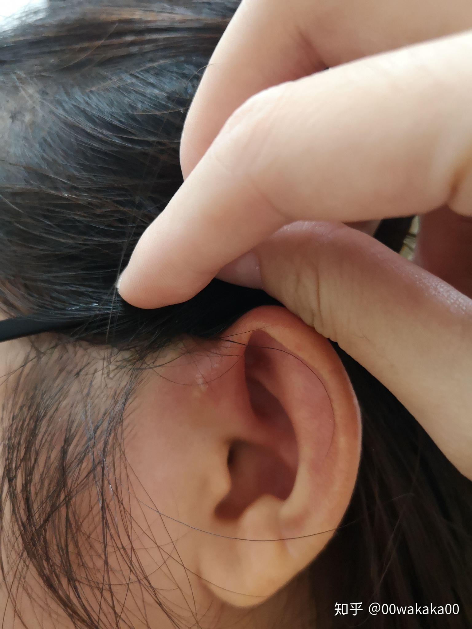 那就说说耳前瘘管那些事儿吧