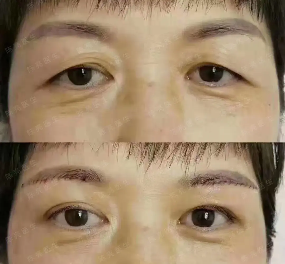 【讨论】一例伴有上睑凹陷和上睑松弛的双眼皮术式选择 - 修复重建和烧伤整形 -丁香园论坛