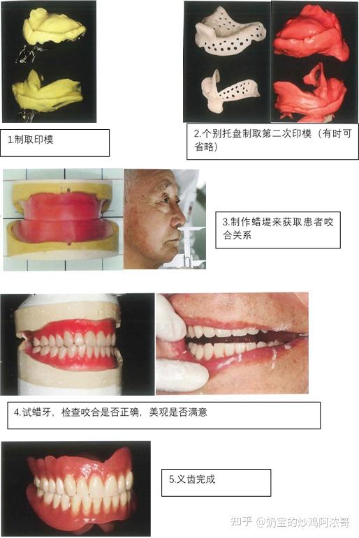 第五次就诊:假牙制作完成,医生为患者做假牙的第一次调整并指导患者