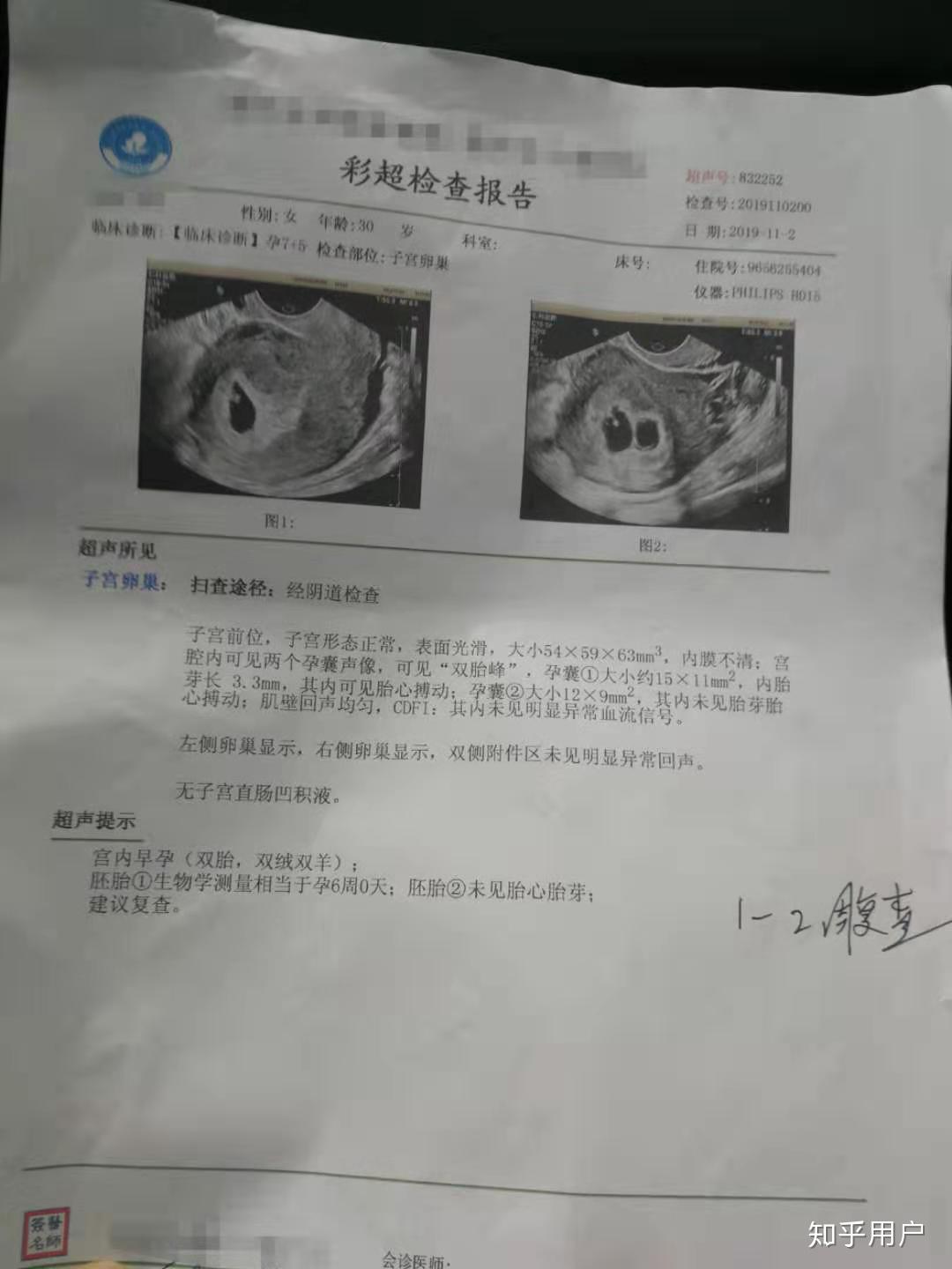 自然流产是怎样的过程? - 知乎