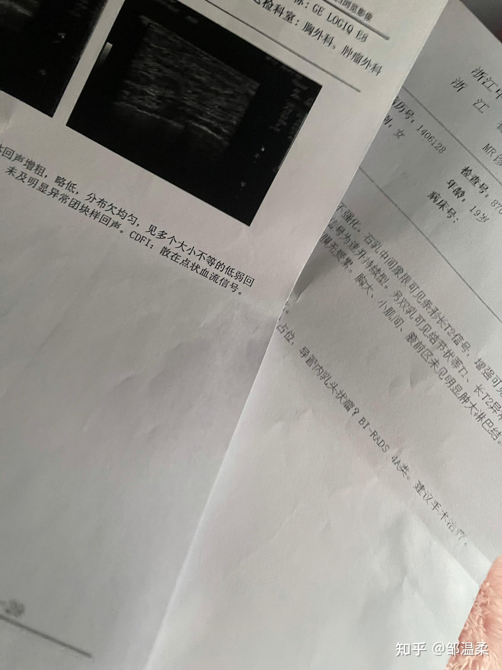 乳腺导管内乳头状瘤必须通过手术治疗吗? - 知乎
