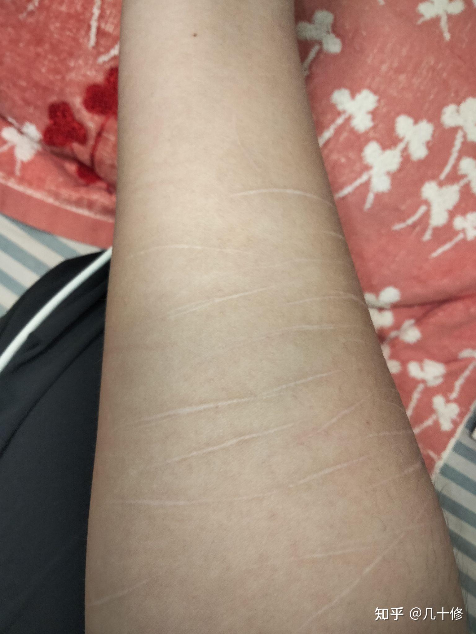 自残过有伤疤的人被看到会被歧视吗? - 知乎