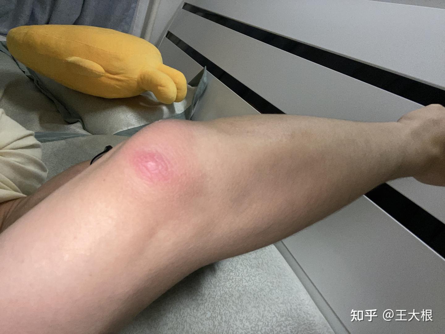 火疖子自救日记 - 知乎