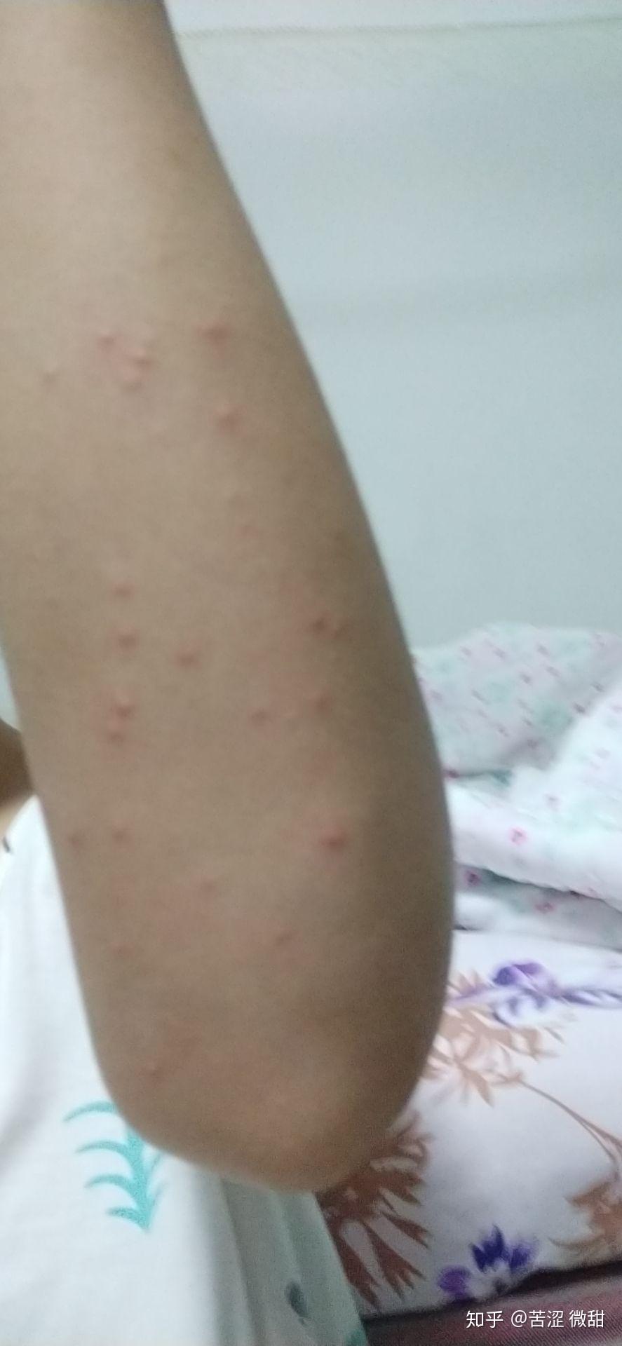 手臂两边长好多像痘痘一样的东西,怎么办? - 知乎