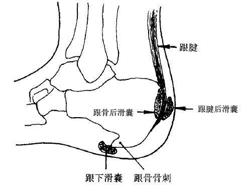 公众号:步姿专家,商务合作:sennogaitvip步态体态研究院跟骨后滑囊炎