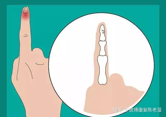 打篮球手指挫伤该如何处理?