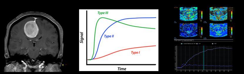 磁共振增强扫描如何量化对比剂效果