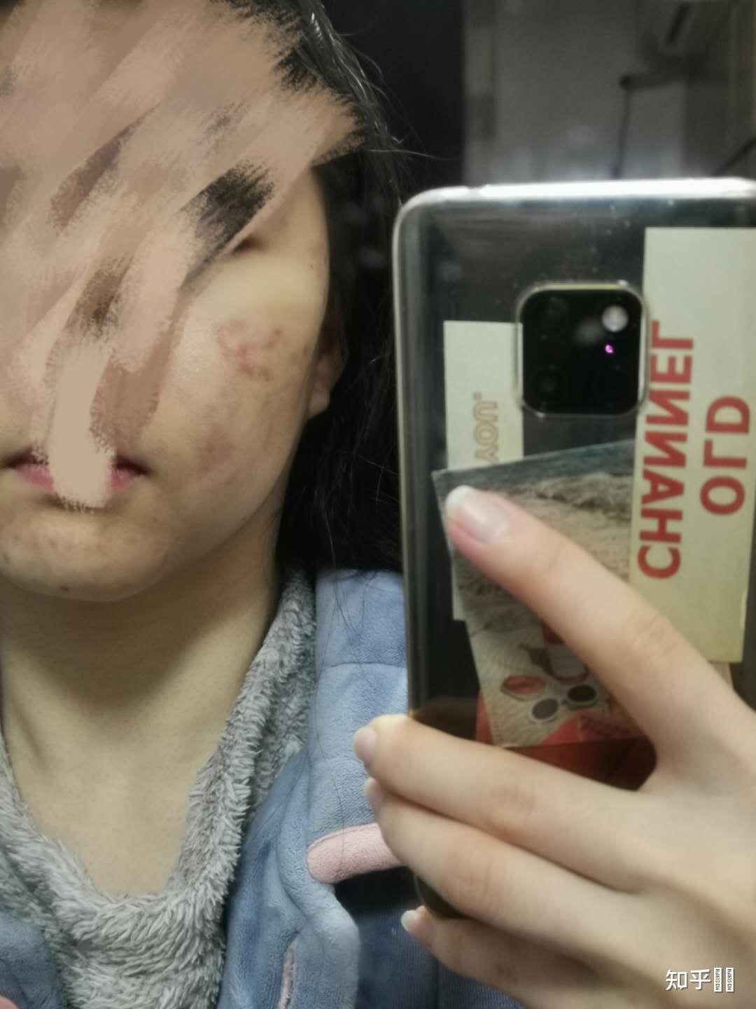 果酸灼伤是什么体验?