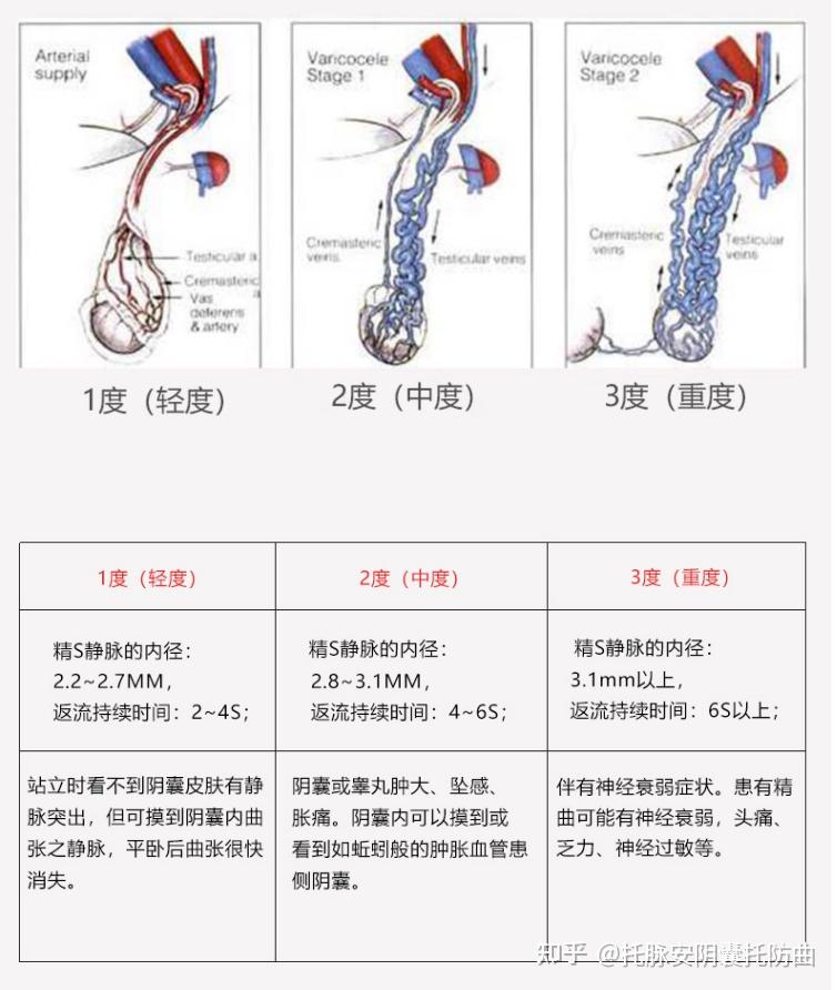 睾丸静脉曲张外观图图片