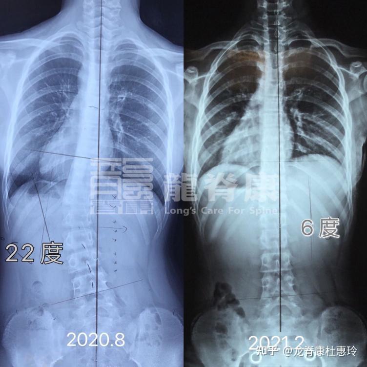 脊柱侧弯在生长发育期内,为什么说“及时治疗”很关键? - 知乎
