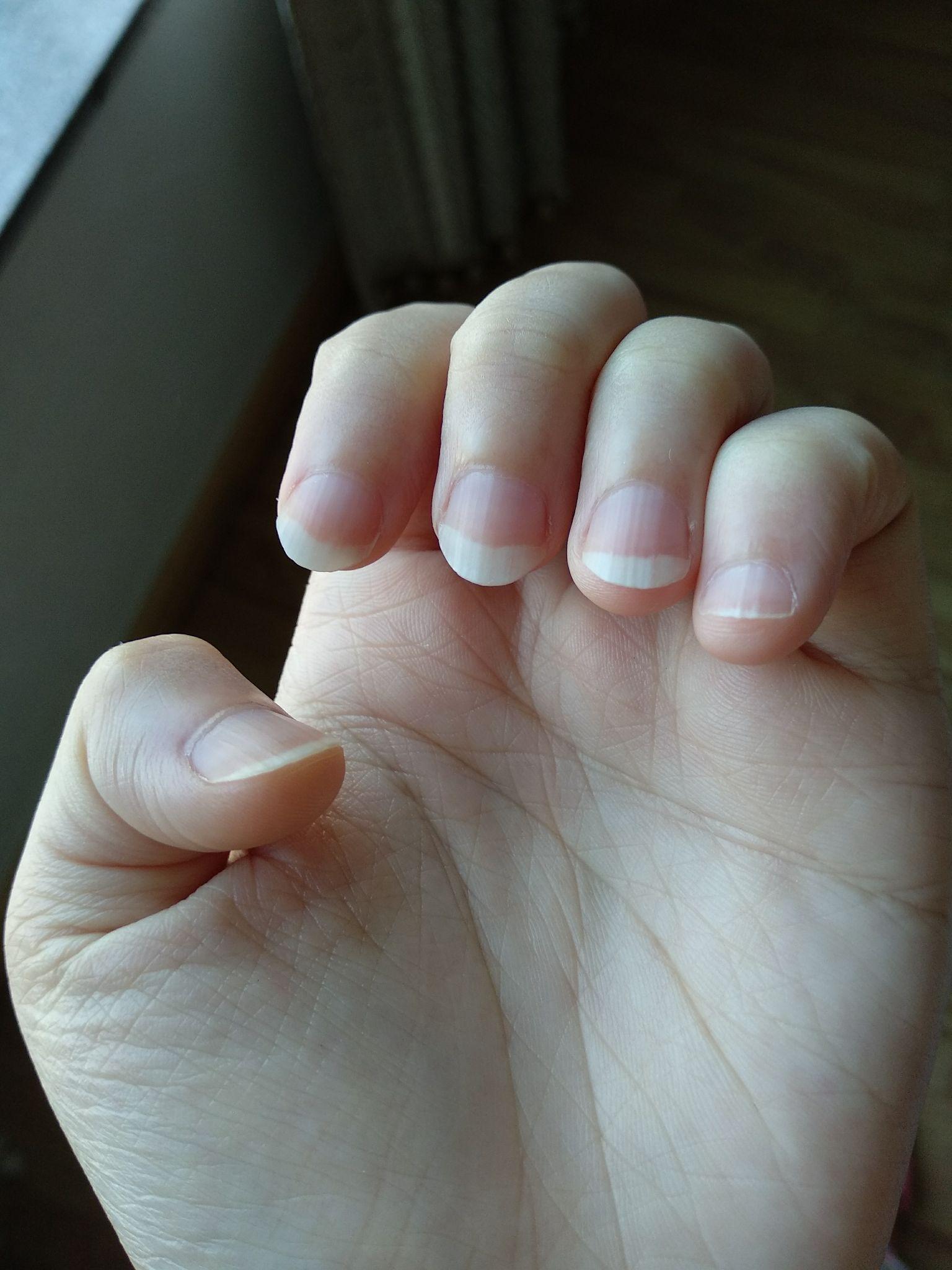 手指甲被咬的超级短怎么办?