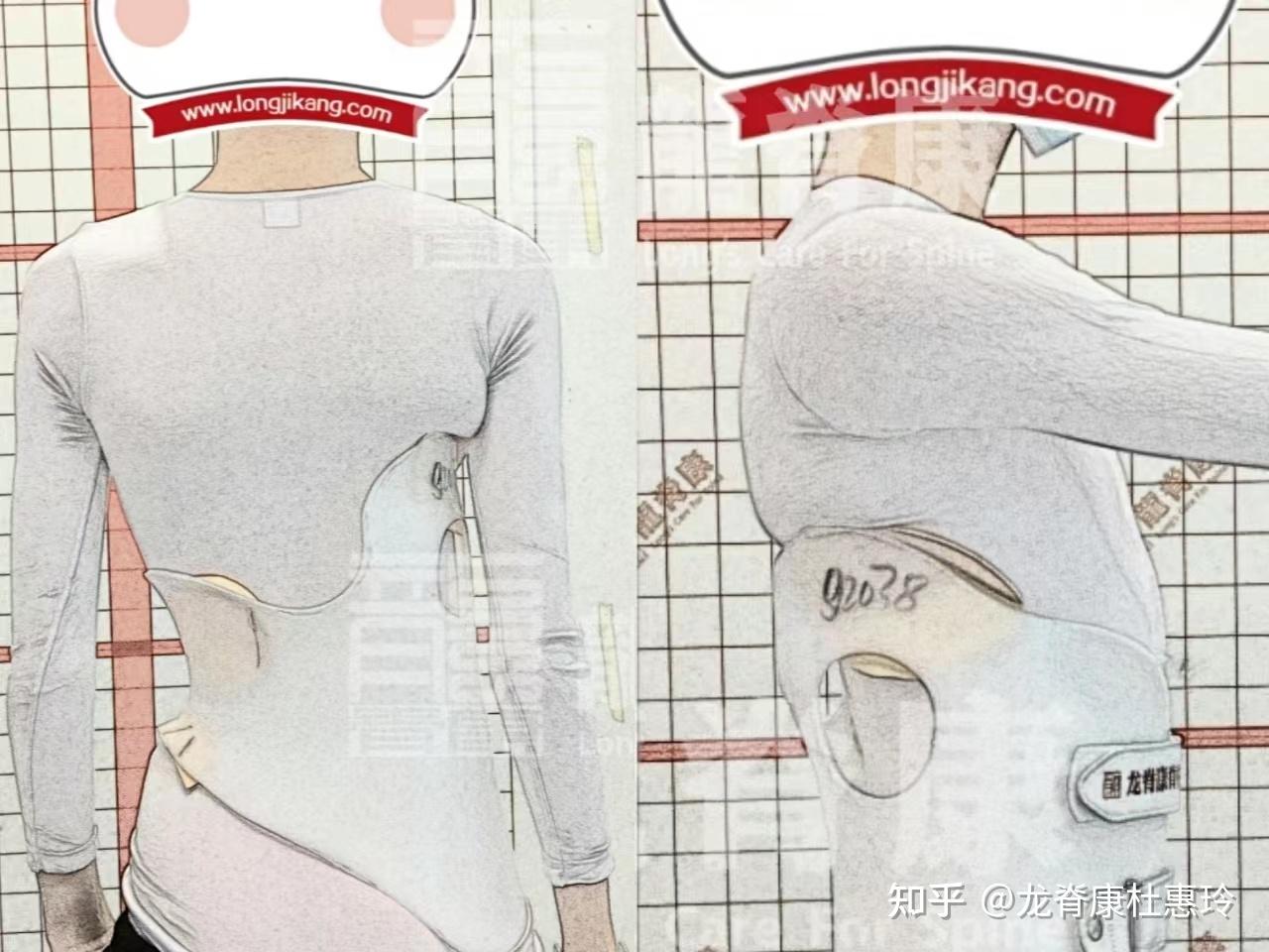 治疗仅仅半年,15岁男孩脊柱侧弯减少22°,剃刀背减少13° - 知乎