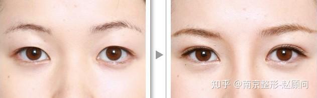 对照着瞧瞧吧!南京玖熙医疗美容1,肿泡眼肿泡眼就是