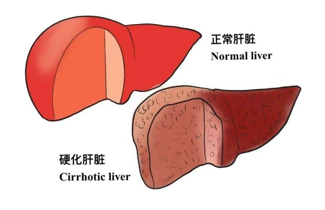 中科西部幹細胞研究院幹細胞讓你的肝重新變柔軟