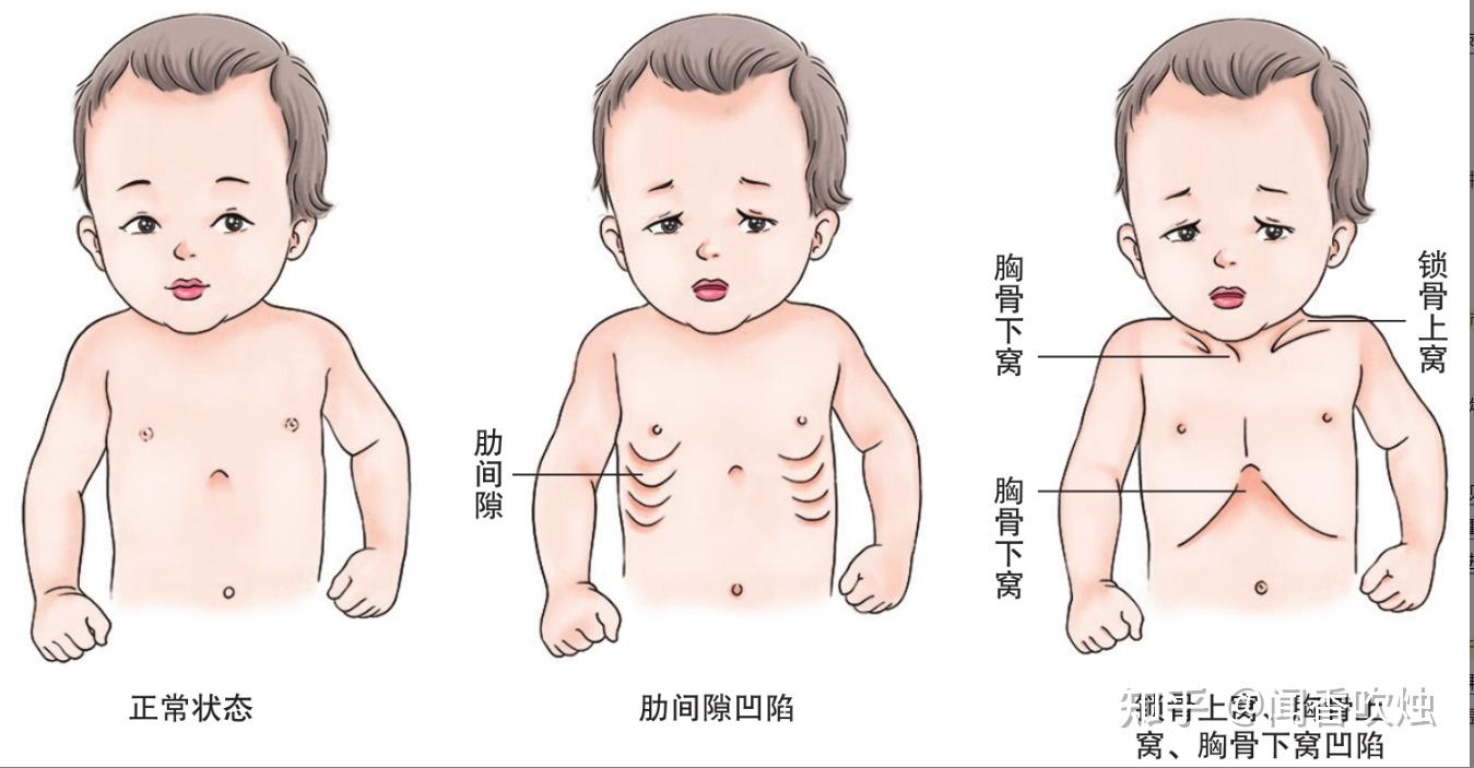 软骨陷窝图片